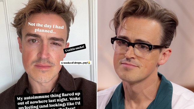 Compilation image of Tom Fletcher on TV and in a social media post announcing his eye condition flare up